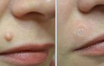 Папилломы на губах: симптомы и методы удаления новообразований
