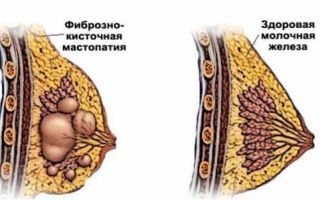 Эдас при мастопатии: состав препарата и его целебное действие