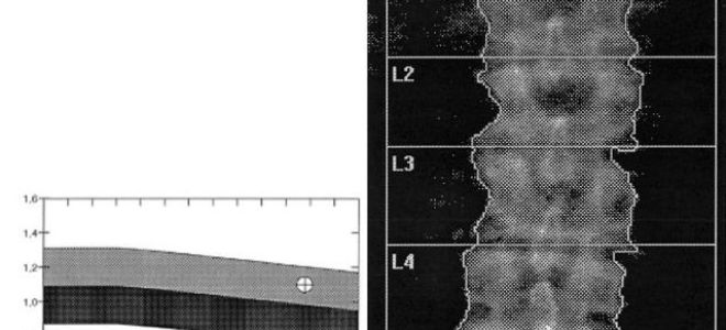 Особенности проведения денситометрии для диагностики остеопороза