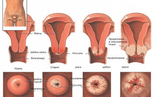 Симптомы рака шейки матки и лечение онкологического заболевания