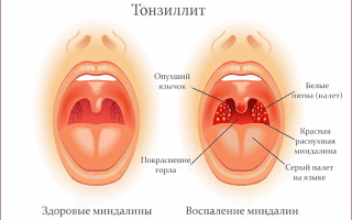 Кашель и боль в горле: лечение медикаментозными средствами