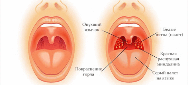 Кашель и боль в горле: лечение медикаментозными средствами