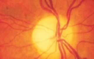 Лечение атрофии зрительного нерва для улучшения кровоснабжения