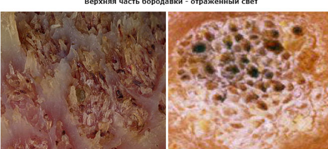 Бородавка под микроскопом: анатомия и структура образования