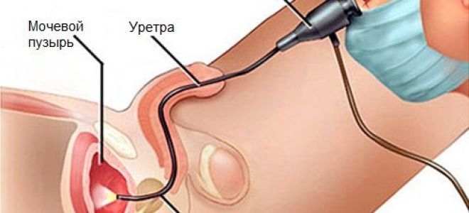 Как лечится переходно-клеточная папиллома мочевого пузыря
