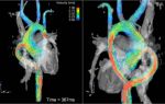 Что показывает магнитно-резонансная томография сосудов сердца