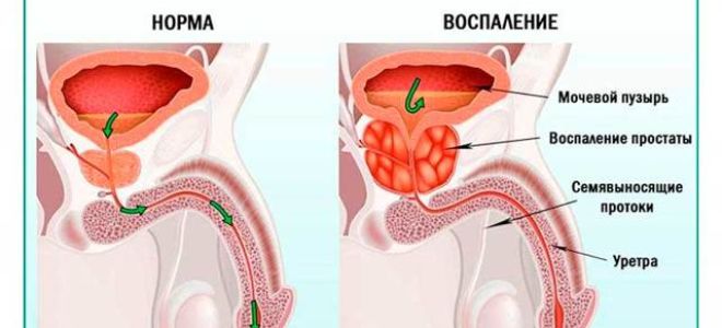 Лечение доброкачественной гиперплазии предстательной железы