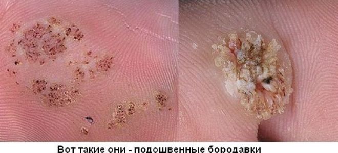 Бородавки на ладонях: причины образования и методы терапии