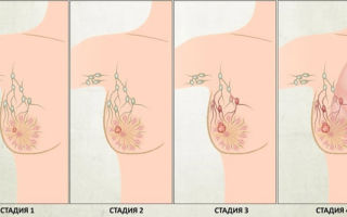 Симптомы рака груди и основные подходы к лечению заболевания