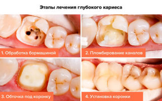 Симптомы глубокого кариеса зубов и методы лечения заболевания
