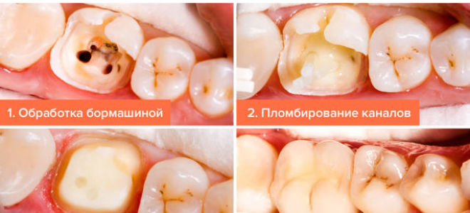 Симптомы глубокого кариеса зубов и методы лечения заболевания