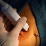 Диффузная мастопатия: форма с преобладанием фиброзного компонента