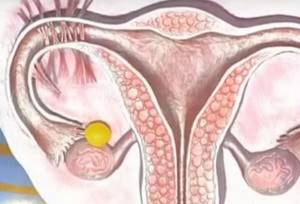 Симптомы кисты в яичнике и основные методы лечения патологии