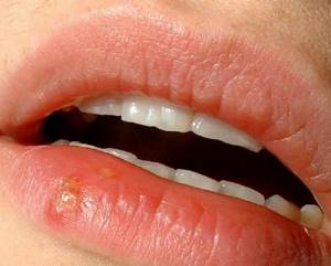 Бородавка на губе: причины появления и методы лечения наростов