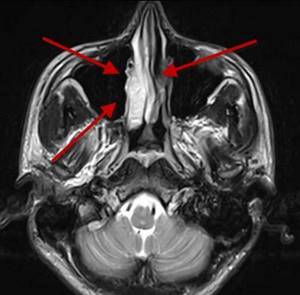 Что показывает магнитно-резонансная томография пазух носа