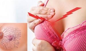 Фиброкистозная мастопатия: симптомы заболевания и методы терапии