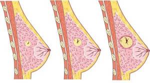 Диффузная фиброзно кистозная мастопатия: особенности болезни