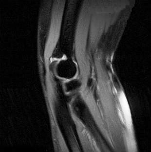 Проведение магнитно-резонансной томографии локтевого сустава