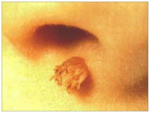 Папилломы в носу: разновидности и методы лечения наростов