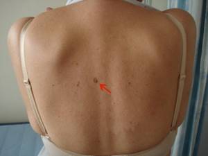 Папилломы на спине: диагностика и лечение новообразований