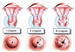 Симптомы лейкоплакии шейки матки и методы лечения патологии