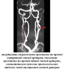 Как проводится магнитно-резонансная томография сосудов шеи