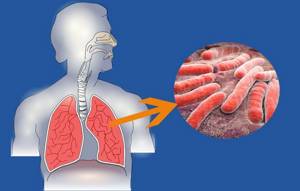 Кашель при туберкулезе: специфические признаки и методы лечения
