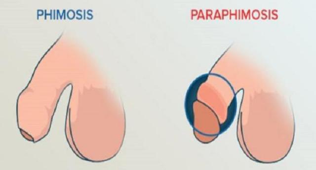 Симптомы парафимоза и основные подходы к лечению заболевания