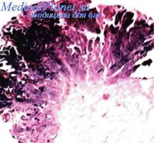 Как лечится переходно-клеточная папиллома мочевого пузыря
