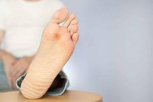 Папилломы на ногах: способы терапии и терапевтические меры