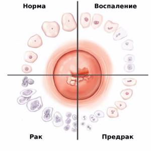 Для диагностики каких патологий задействуется метод кольпоскопии