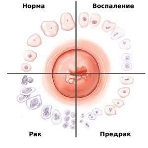 To diagnose which pathologies the colposcopy method is used