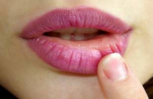 Папилломы на губах: симптомы и методы удаления новообразований