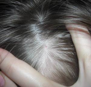Бородавка на голове в волосах: диагностика и лечение нароста