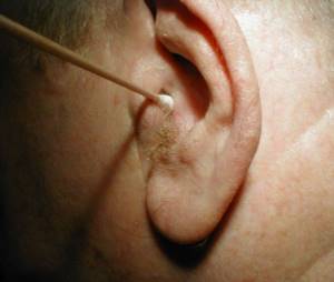 Папиллома в ухе: признаки развития и способы устранения нароста