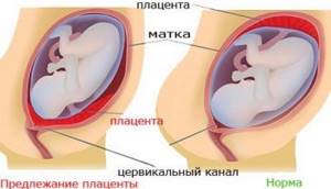 Признаки плацентарного предлежания и прогноз родоразрешения