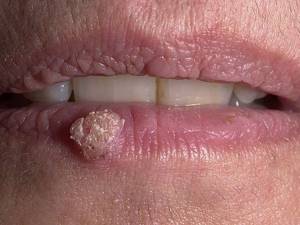 Бородавка на губе: причины появления и методы лечения наростов