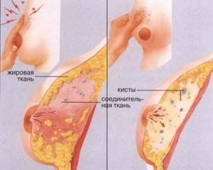 Противозачаточные при мастопатии: механизм действия и эффект
