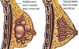 Симптомы и основные методы лечения фиброзно-кистозной мастопатии