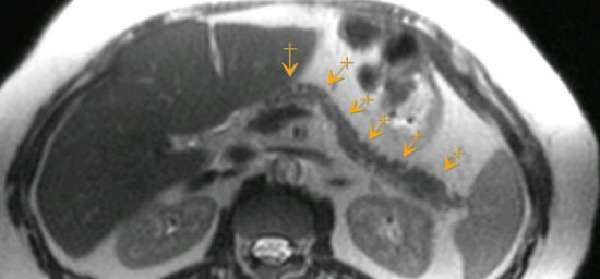 Показания к магнитно-резонансной томографии поджелудочной железы