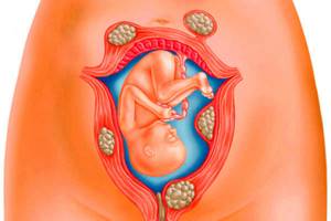 Симптомы миомы матки и методы лечения доброкачественной опухоли
