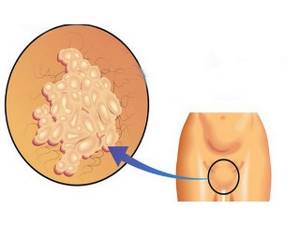 Бородавки на влагалище: диагностика и лечение новообразований