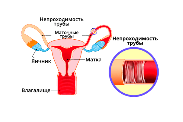 Лечение мужского бесплодия с помощью гормонов и физиопроцедур