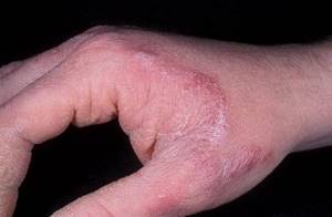 Консультация миколога при грибковых поражениях кожи и слизистых