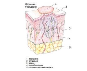 Бородавка под микроскопом: анатомия и структура образования