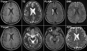 Какие патологии и нарушения выявляет МРТ сосудов головного мозга