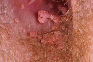 Папилломы на коже: симптомы и методы лечения новообразований