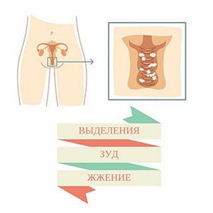 Симптомы и основные методы лечения вагинального кандидоза
