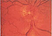 Симптомы неврита зрительного нерва и методы лечения патологии