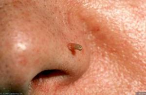 На носу появилось уплотнение как бородавка: как лечить нарост